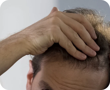 Hair transplant