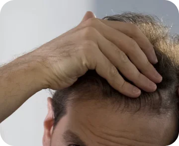 Hair transplant